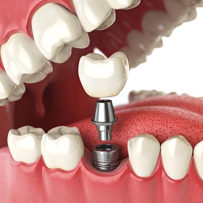 Dental implants computer graphic side view