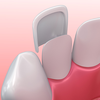 Photo representation of the porcelain veneers process