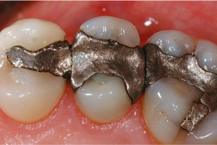 closeup of amalgam dental fillings