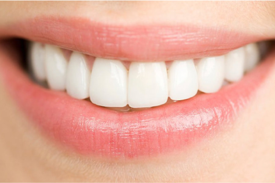 woman's smile showing off porcelain veneers