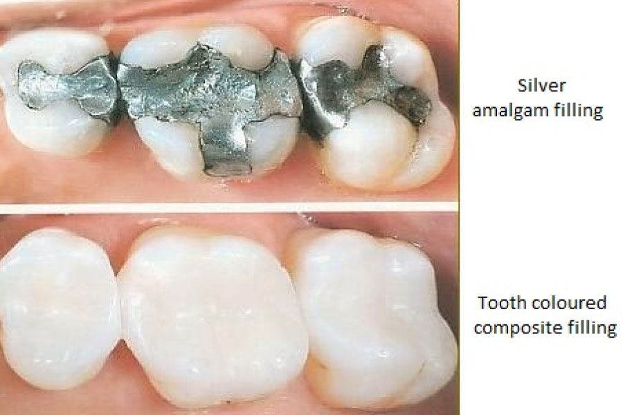 comparison between amalgam and composite dental fillings