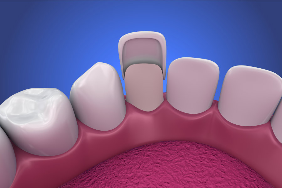 dental veneer model